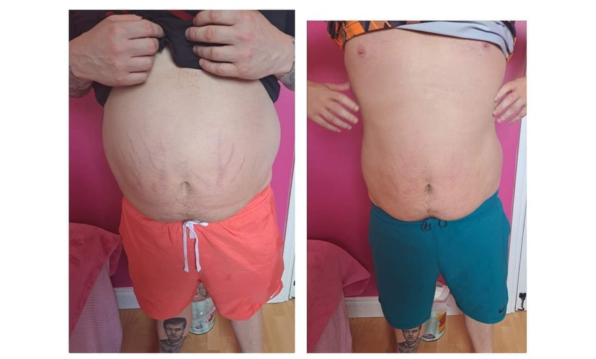 Image 4: Fat Freezing with Complimentary Meal Plan at Liposuction Belfast