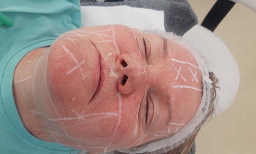 Image 4: Lift and Tone with Advanced HIFU for Face With or Without Neck