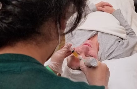 One Microneedling Treatment with Hyaluronic Acid (HA) Serum - Ethereal Rejuvenation Clinic Mercer Island