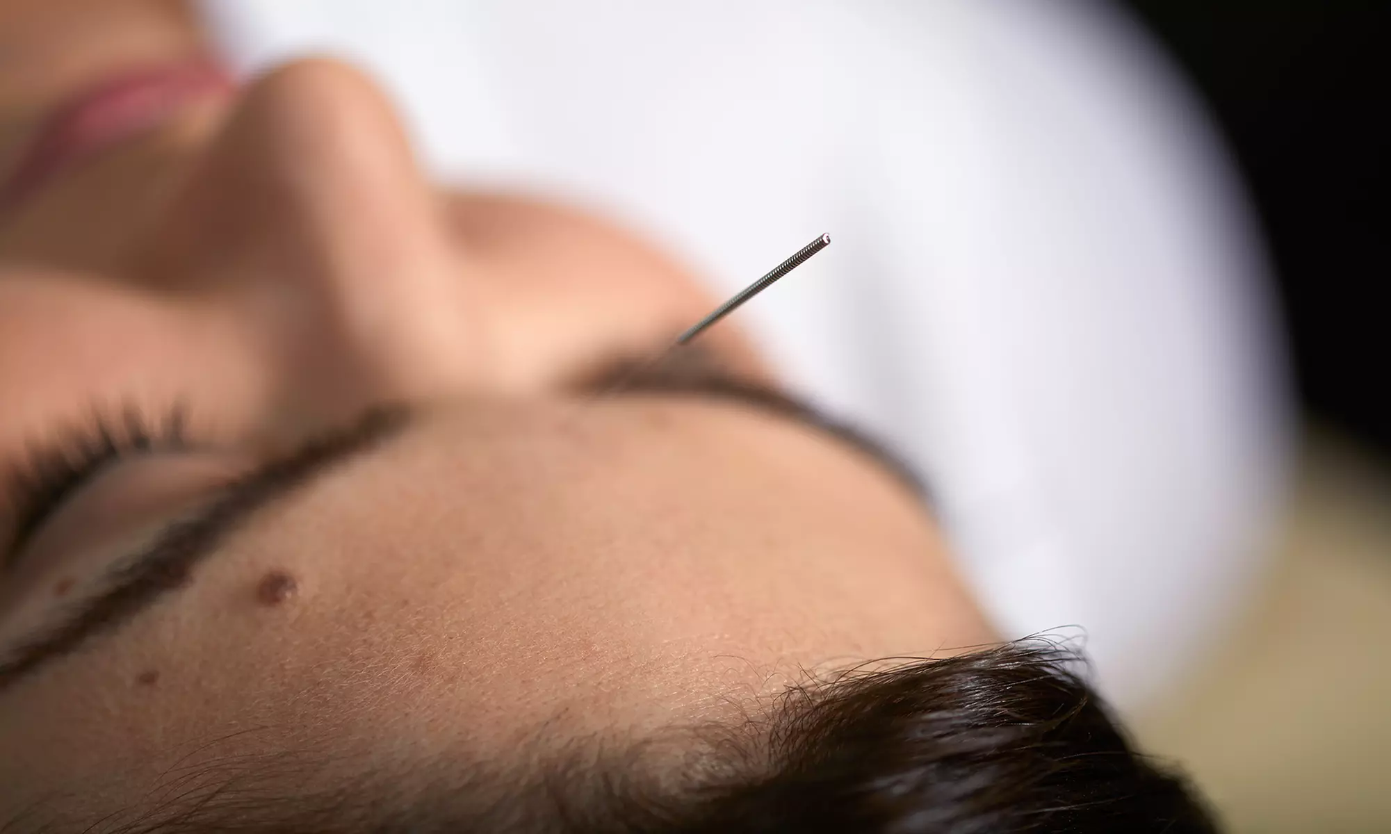 $90 Worth of Acupuncture - Primary Image