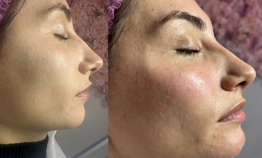 Image 9: Revitalize Your Look with Dermal Fillers
