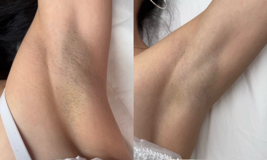 Image 3: Up to 40% Off on Laser Hair Removal at Vi Skin