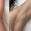 Image 3: Up to 40% Off on Laser Hair Removal at Vi Skin
