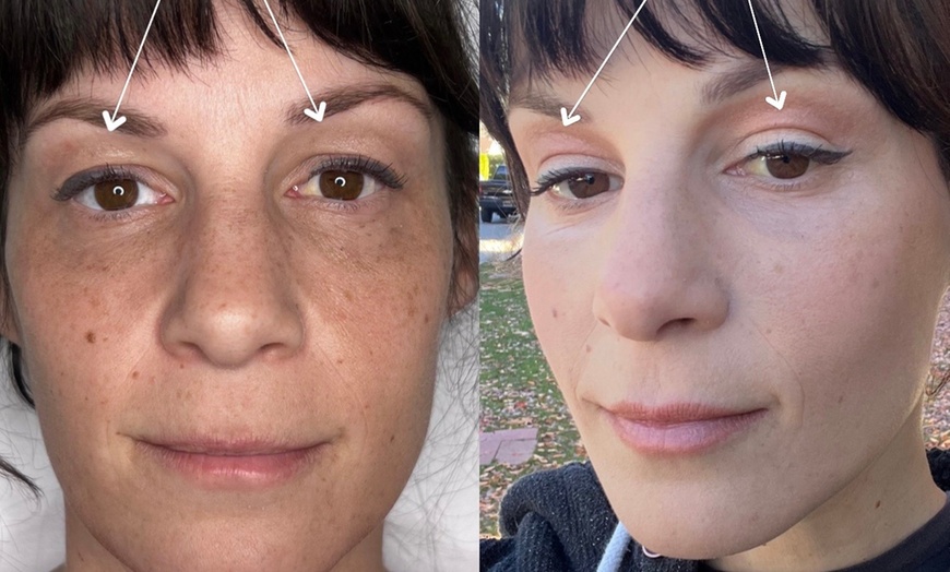 Image 2: Refresh your look with non-surgical blepharoplasty options