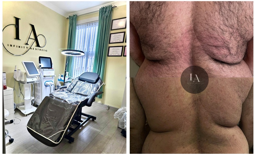 Image 1: Fat-Dissolving Injection Sessions at Infinity Aesthetics London