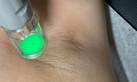 Unlimited Laser Hair Removal Sessions for ONE YEAR on One Area - Brio Med Spa