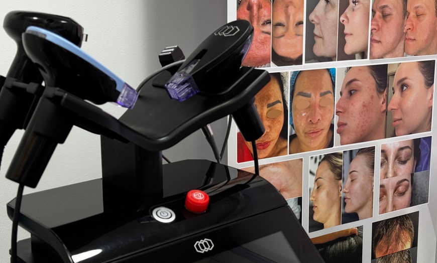 Image 5: Revitalize with Lumecca IPL for Full Face, Neck and Chest
