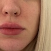 Image 2: Up to 51% Off on Injection - Filler and Freezer at Precision Wellness Center