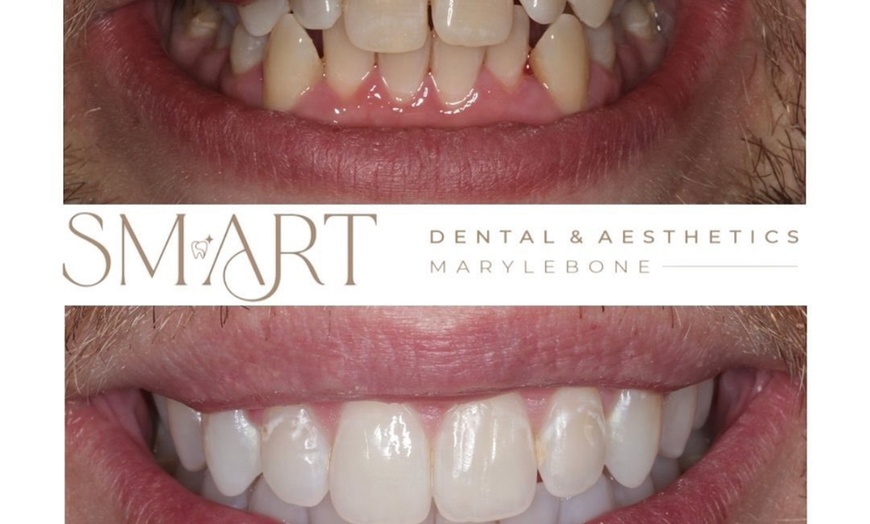 Image 11: Home Teeth Whitening Kit at Smart Dental and Aesthetics Clinic