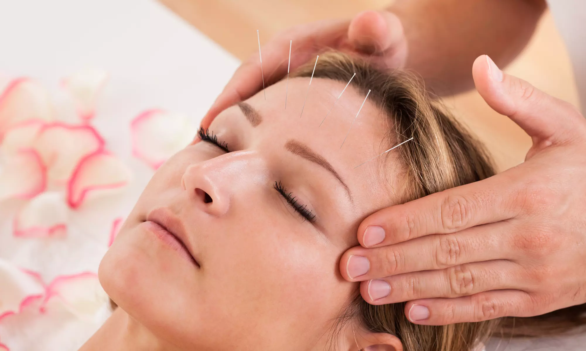 $999 for Facial Acupuncture Package at Nature's Balance Acupuncture ($1,500 Value) - Primary Image