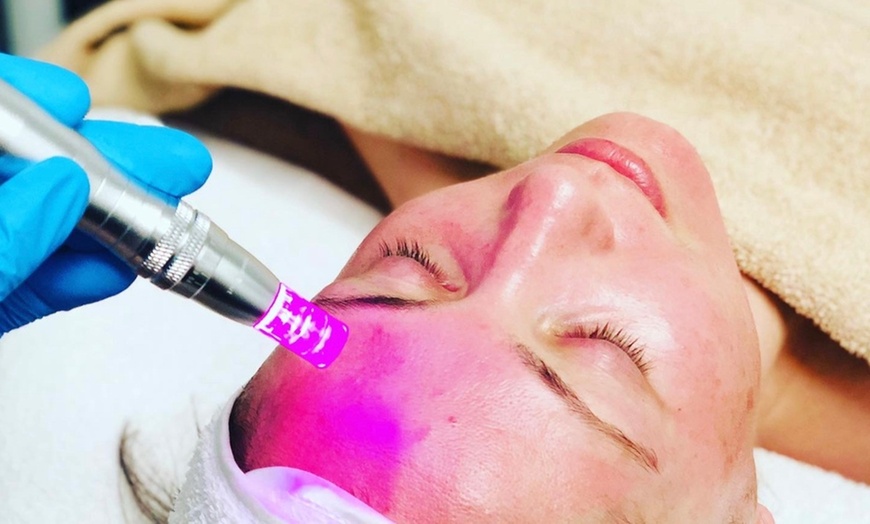 Image 1: Face Microneedling + LED Therapy