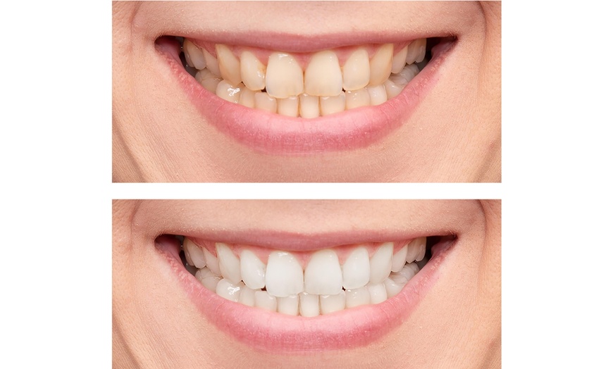 Image 4: One 60-Minute Premium Teeth Whitening at Skinnovate Clinic