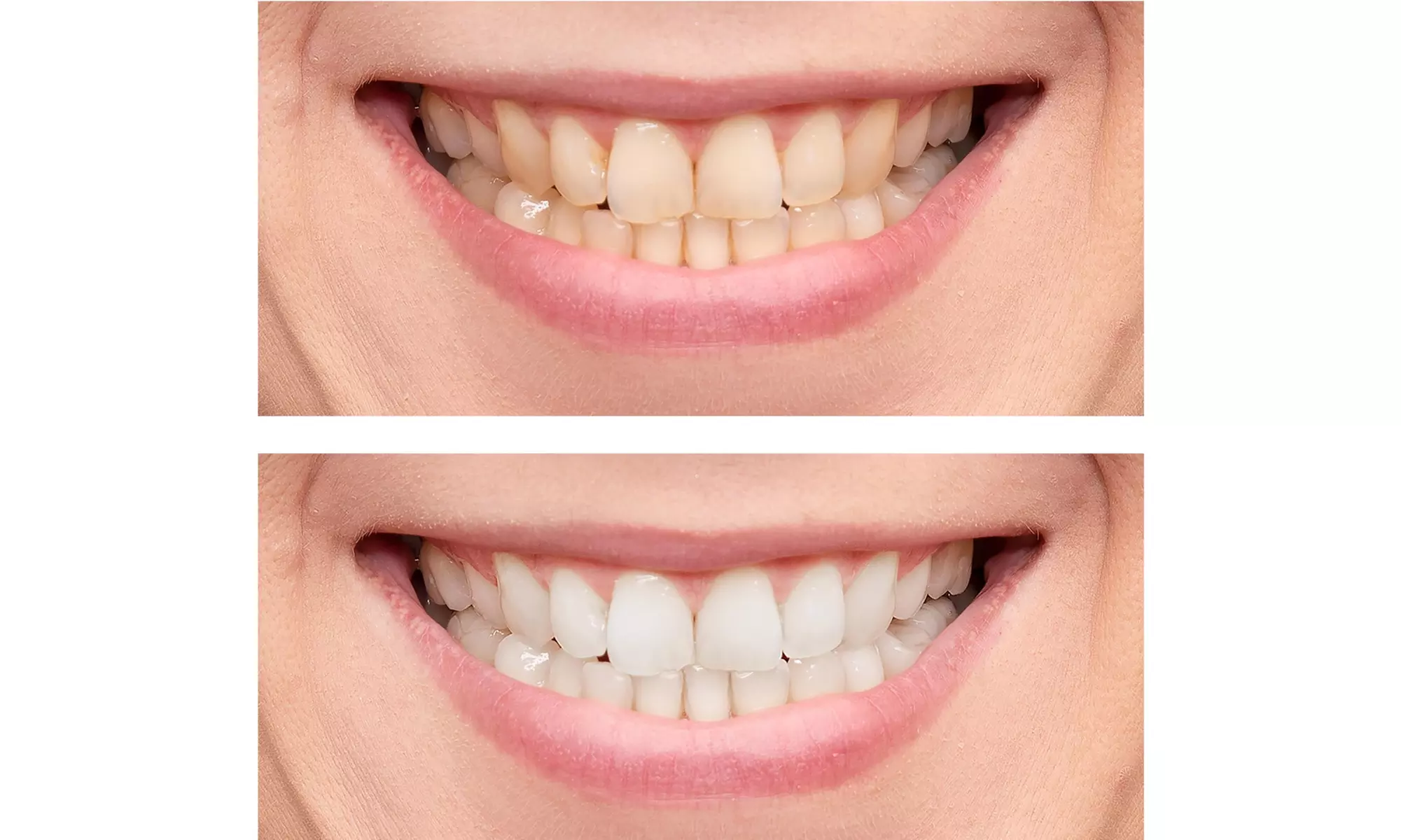 One 60-Minute Premium Teeth Whitening for One or Two at Skinnovate Clinic (Up to 73% Off) - Image 4