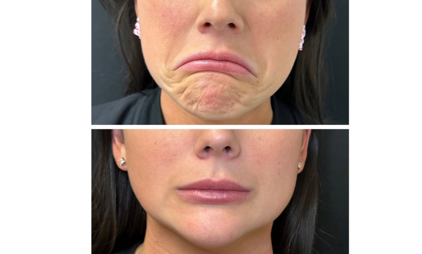 Image 6: Youthful Confidence Awaits with 20, 40, or 60 Units of Botox Treatment