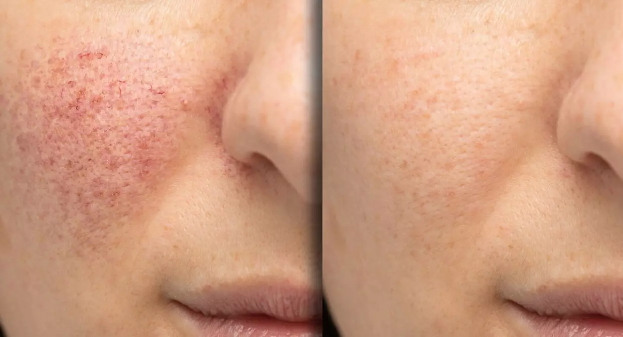 Up to 39% Off on Laser Skin Resurfacing at JC Plastic Surgery
