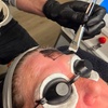 Image 4: Effectieve carbon laser peeling voor huidverjonging en collageenboost