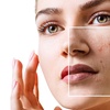 Image 1: Laser Dark Spot Removal Options for One Spot or 1, 3, or 6 Full Face