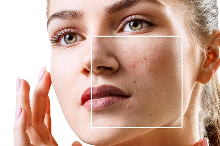 Laser Dark Spot Removal  - 1 Spot - Hyperbaric Wellness