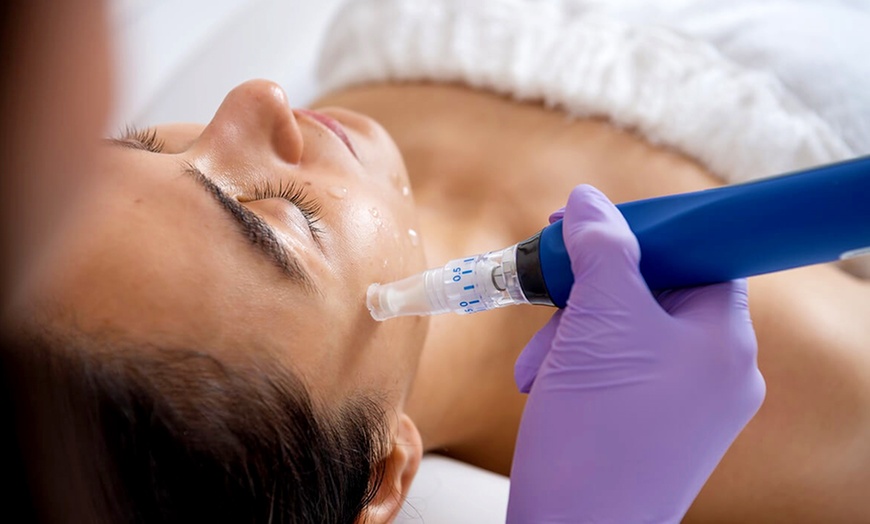 Image 1: 1 o 3 sesiones de dermapen facial con vitaminas o exosomas