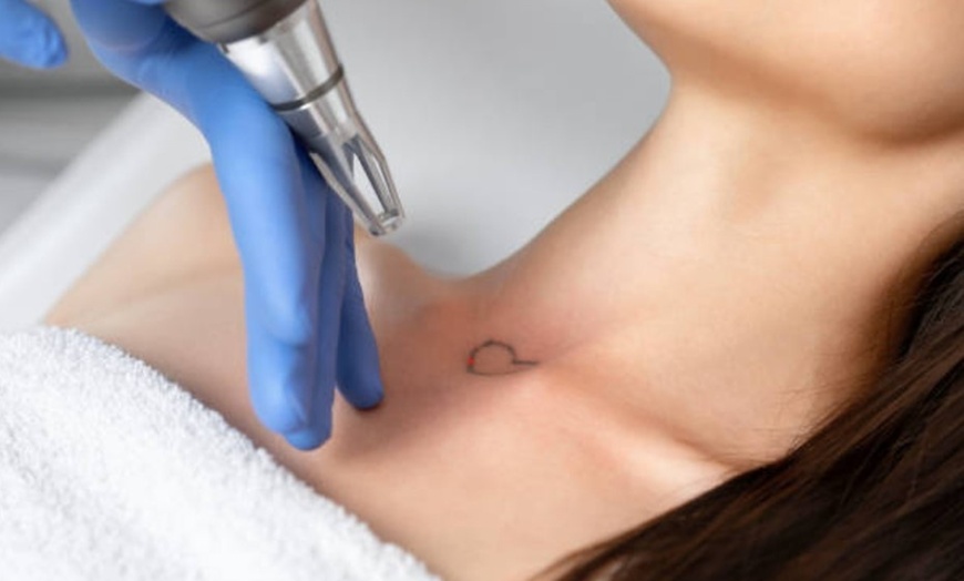 Image 3: Eliminación de micropigmentación o tatuajes con láser 