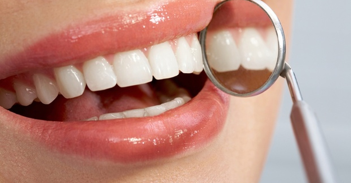 Limpieza bucal profunda con pulido y fluorización en Sevilla