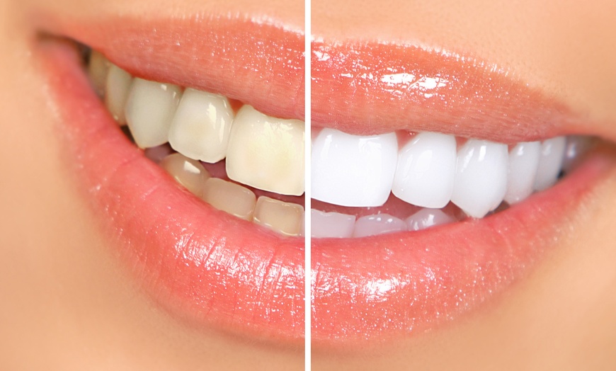 Image 1: Teeth Whitening - Traditional at 3d Lipo London