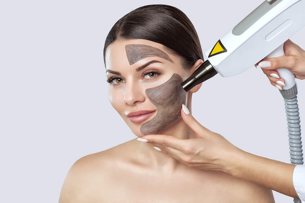 Up to 60% Off Carbon Laser Peel at Luxury MedSpa