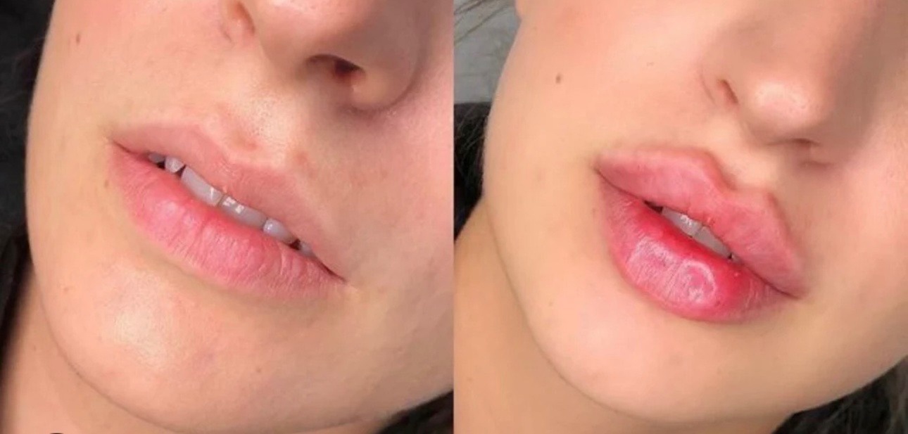 Get Fuller Lips with 1ML or 2ML Hyaluron Lip Filler