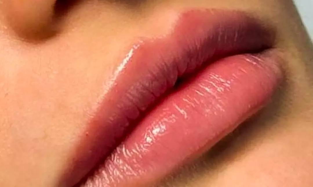 Enhance Your Features With 0.5 ml, 1ml or 2ml Fillers