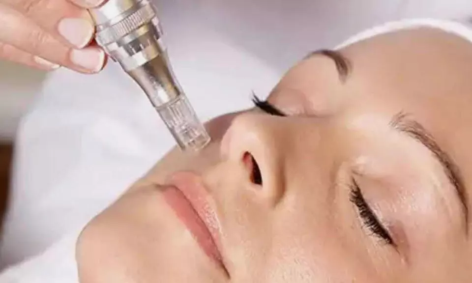 Dermapen Skin Needling or Micro- Needling - (Up to 67%Off)