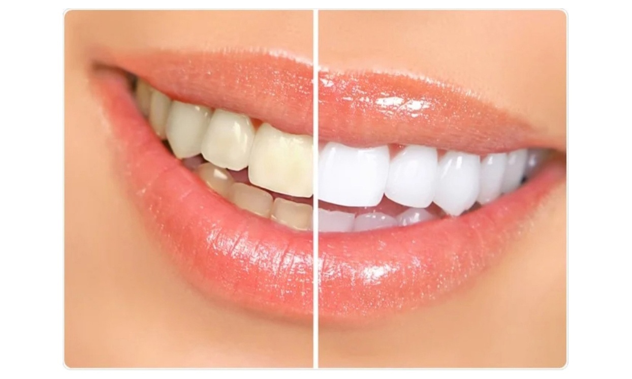 Teeth Whitening Treatment at Studio hair & co