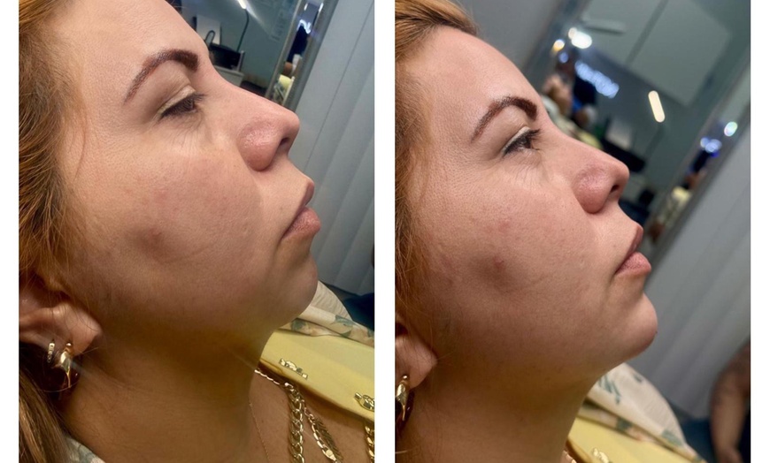 Image 2: Revitalize with Restylane Syringe Options (1.0mL)