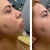 Image 2: Revitalize with Restylane Syringe Options (1.0mL)