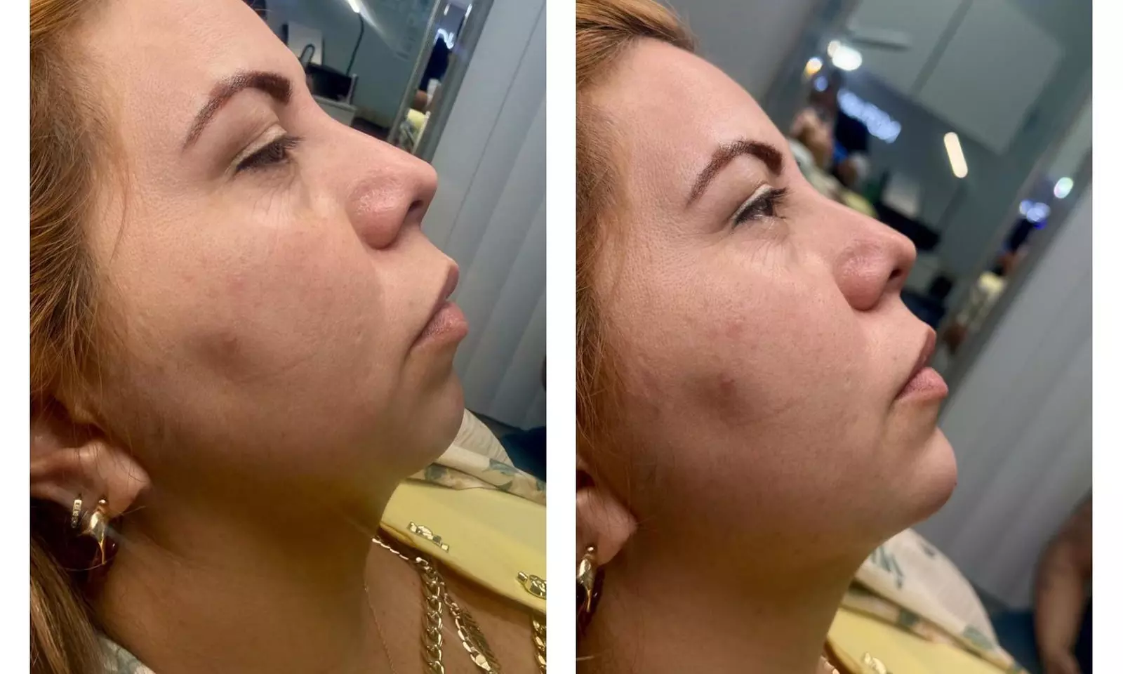 Revitalize with Restylane Syringe Options (1.0mL)