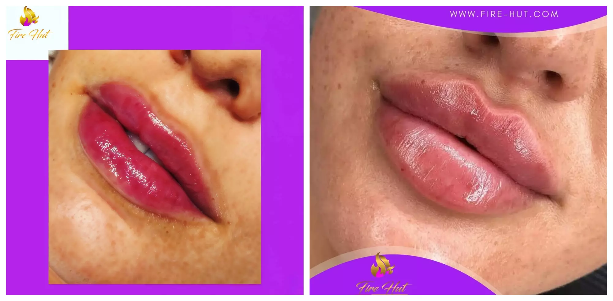 Up to 2ml Dermal Filler Packages for Beautifully Enhanced Features (Up To 72% Off) - Primary Image