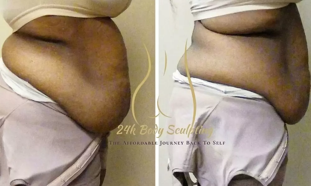 Transform w/ One, Two or Four 45 Minute Ultrasonic Cavitation Sessions