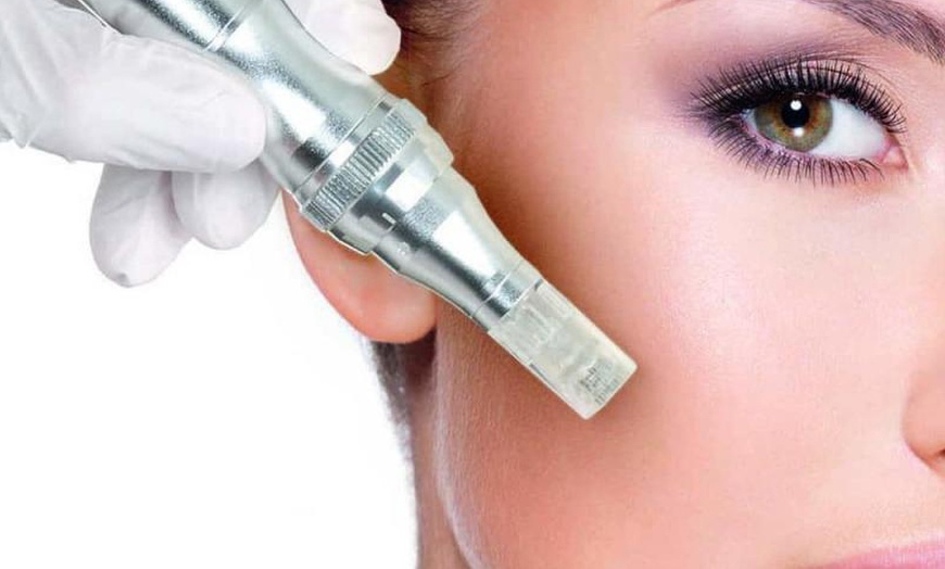 Image 1: Microneedling facial con ácido hialurónico, vitaminas y colágeno