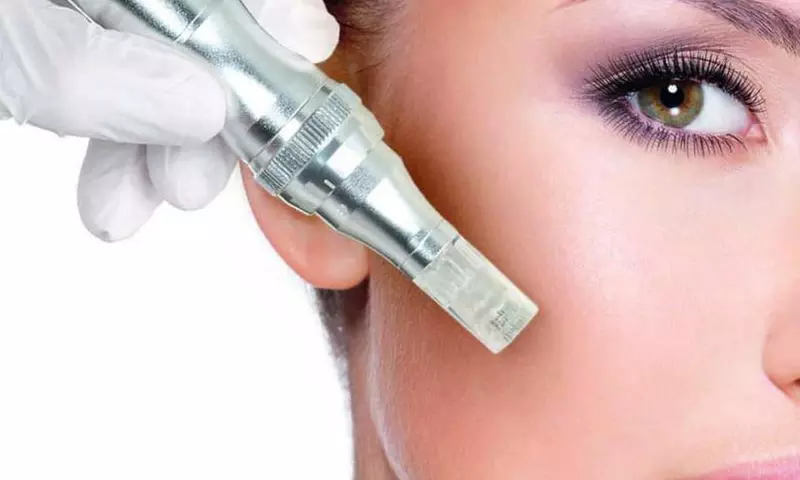 Microneedling facial con ácido hialurónico, vitaminas y colágeno