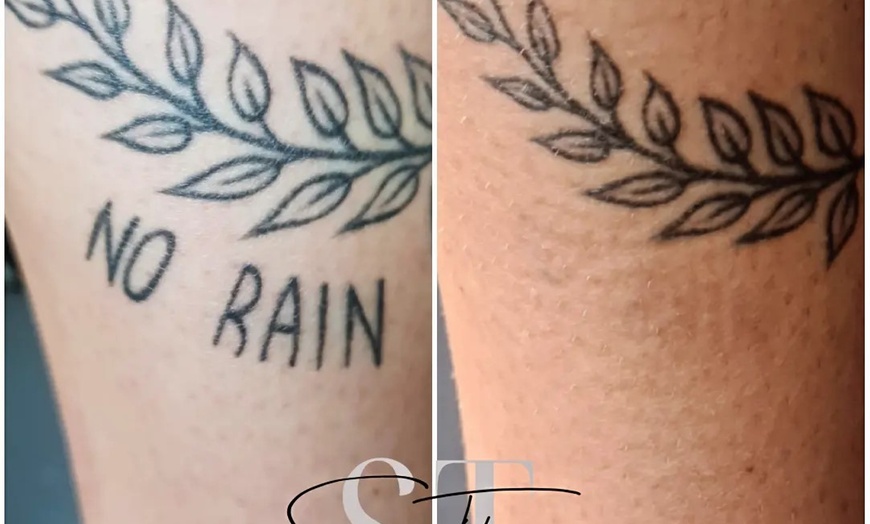 Image 3: Up to 86% Off on Tattoo Removal at Sure Thing Studio