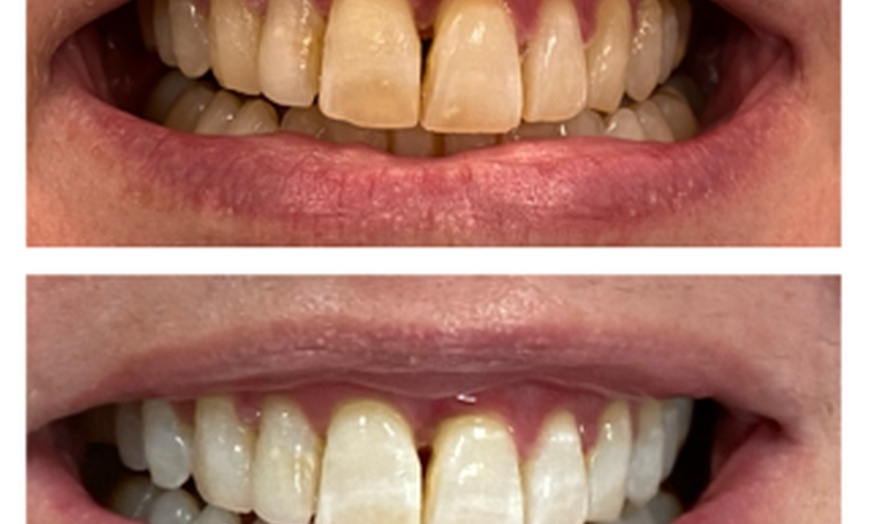 Image 6: Get a Brighter Smile with Phillips Zoom Whitening! Teeth Whitening