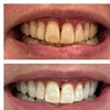 Image 6: Get a Brighter Smile with Phillips Zoom Whitening! Teeth Whitening