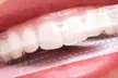 Teeth Whitening Strips from Brighten Up Dental Clinic (Up to 53% Off) - Second Medium