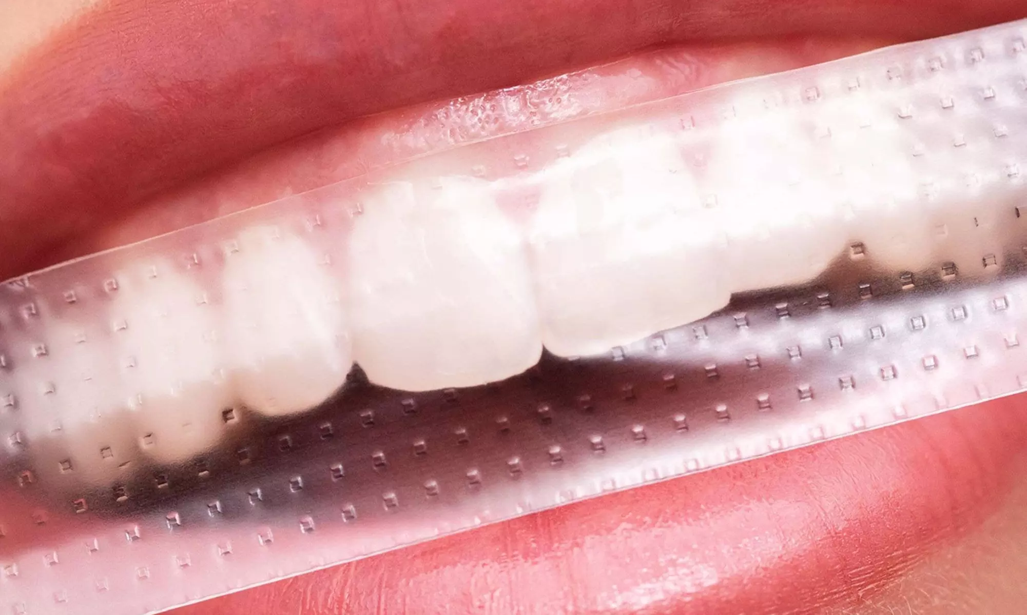 Teeth Whitening Strips from Brighten Up Dental Clinic