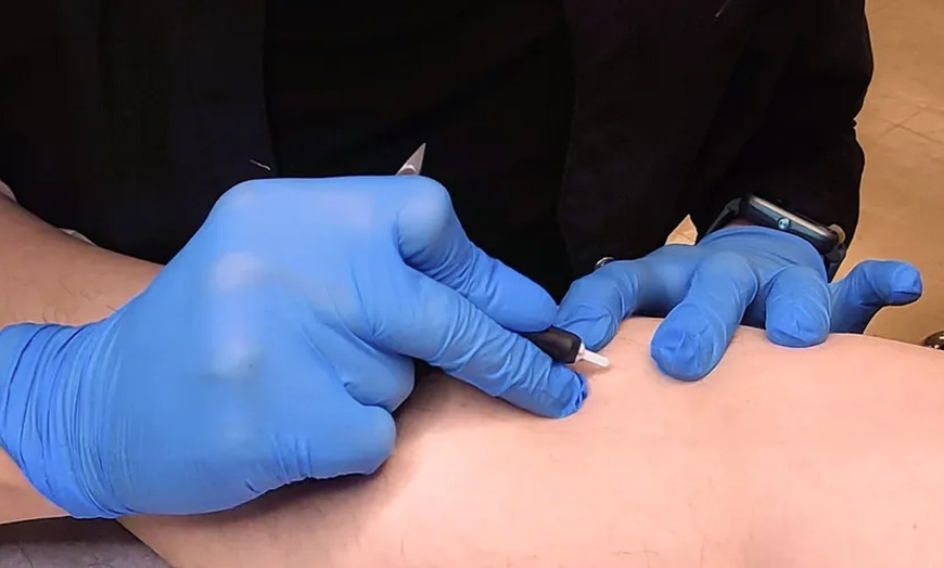 Image 2: Remove Unwanted Hair with One or Two 30-Min Electrolysis Sessions