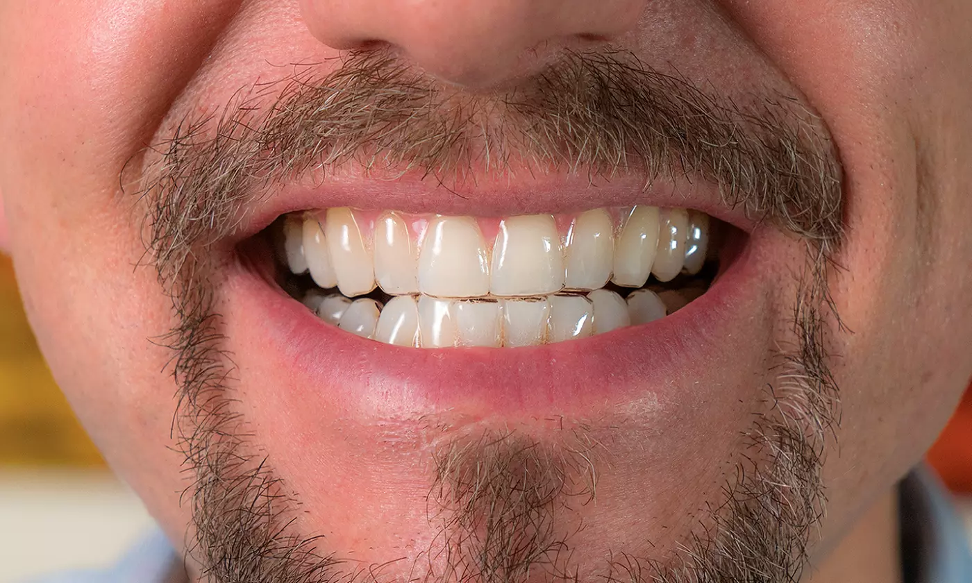 At-Home Impression Kit for Truly Invisible Aligners Plus $200 Off Aligners from SnapCorrect (96% Off)  - Second Medium