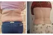 One, Two, or Three Fat Freezing Treatments with Complimentary Meal Plan at Liposuction Belfast (Up to 67% Off) - Image 5
