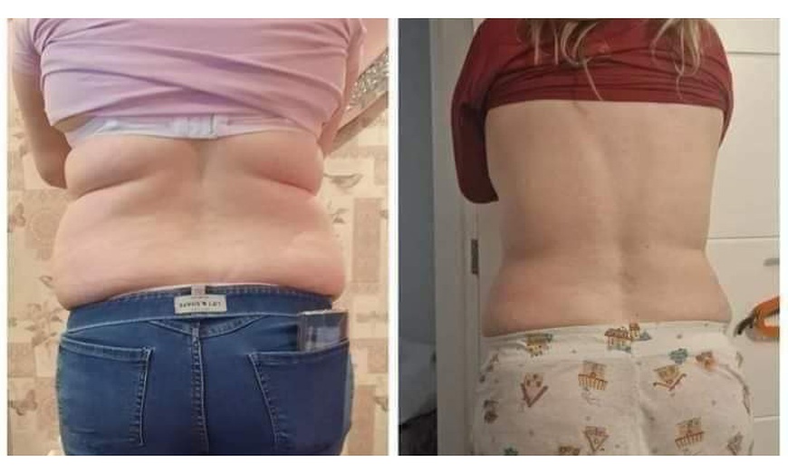 Image 5: Fat Freezing with Complimentary Meal Plan at Liposuction Belfast