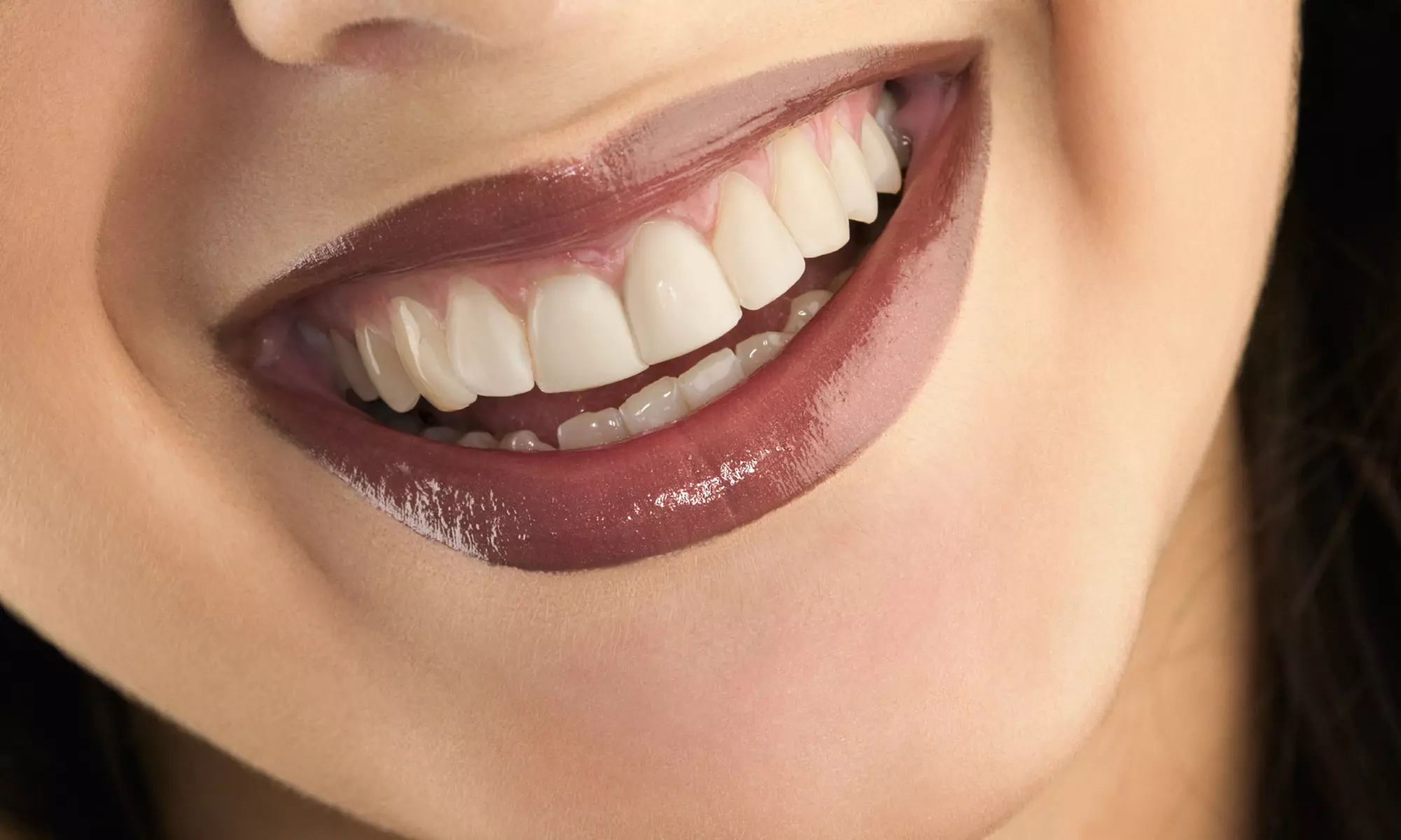 Individual Tooth Gem or 1, 2, or 3 In Office Teeth Whitening (70 min)