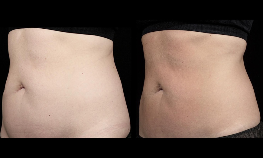 Image 2: Ultrasonic Fat Reduction at Ethereal Rejuvenation Clinic