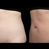 Image 2: Ultrasonic Fat Reduction at Ethereal Rejuvenation Clinic